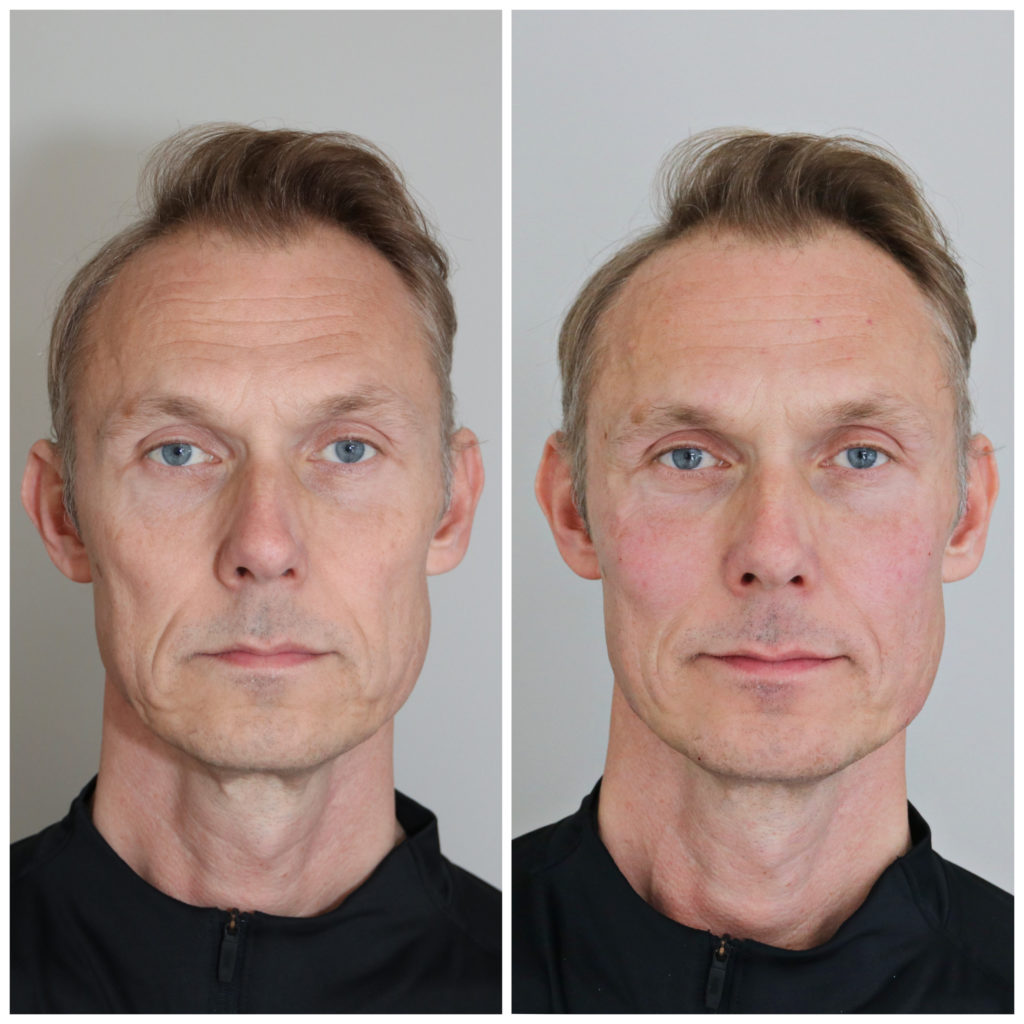 Facelift - avancerad injektionsbehandling med fillers och botox